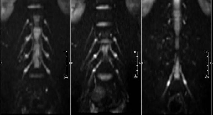 Diffusion-Weighted MR Neurography in a healthy volunteer