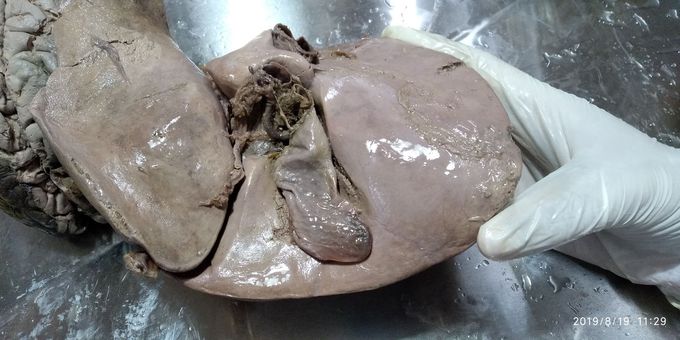 Posterior view of liver