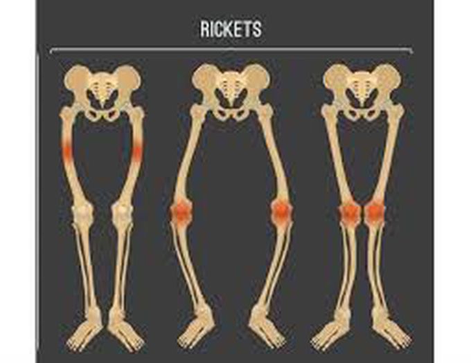 Treatments of rickets