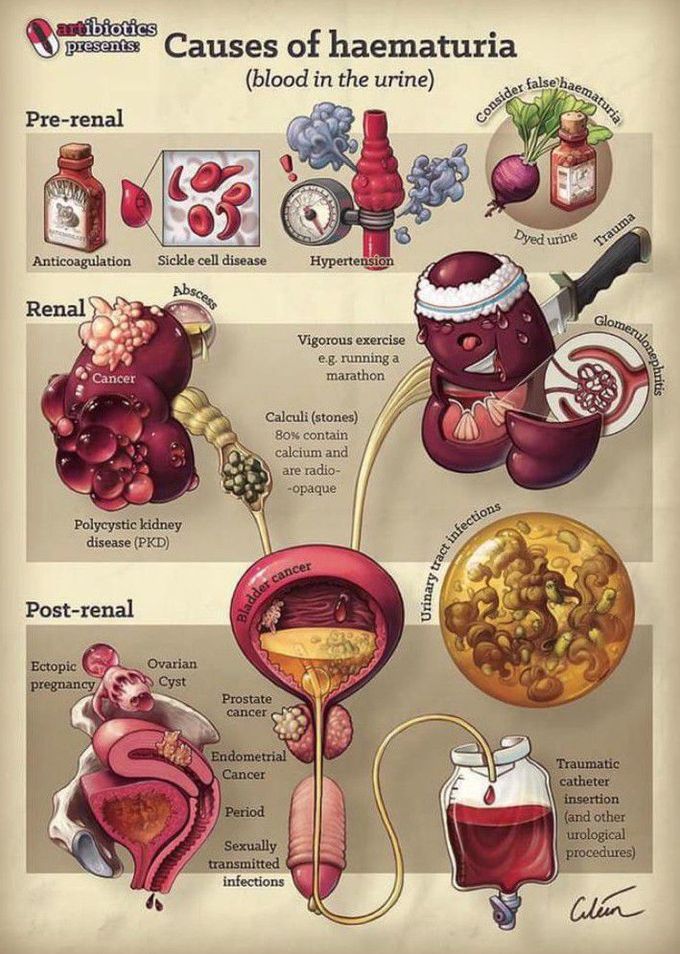 Hematuria