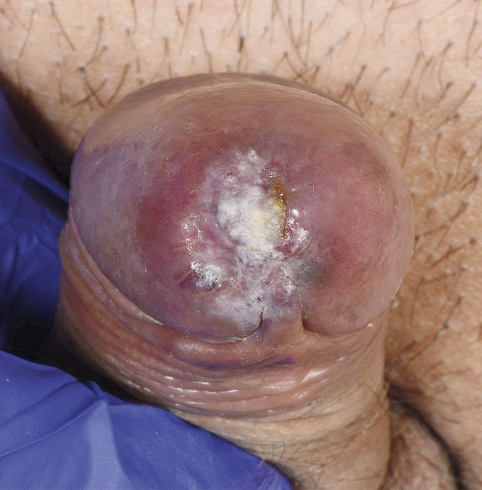 Penile Kaposi’s Sarcoma