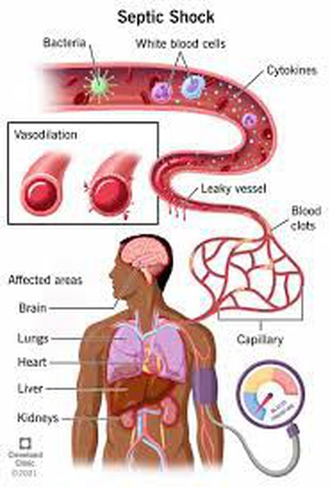 Cause of septic shock