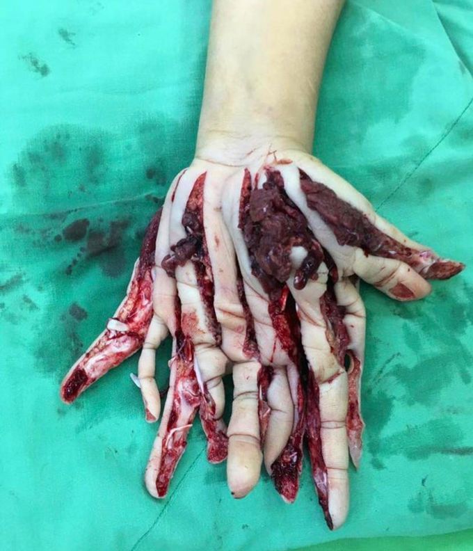 Case of a patient who got his hand stuck in an animal feed blender/shredder!! 