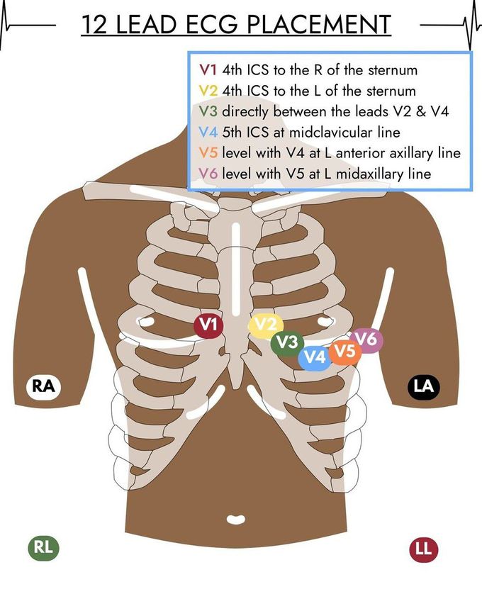 12 Lead Placement