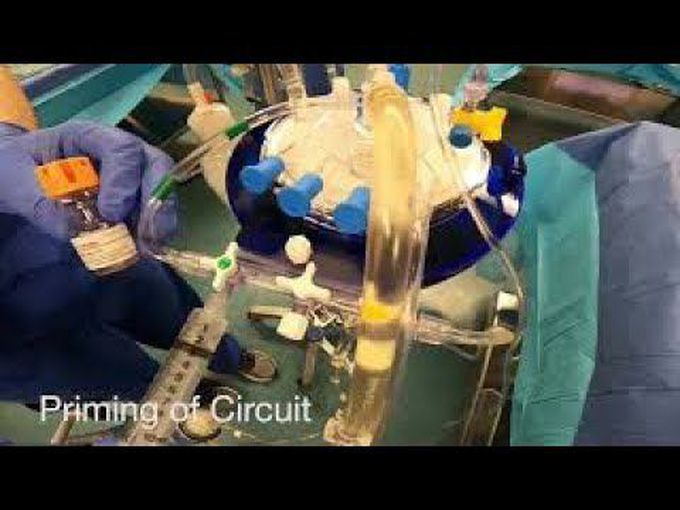 Normothermic Ex vivo Lung Perfusion: Toronto Protocol