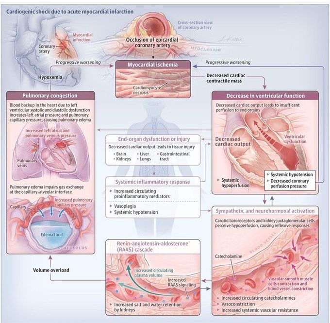 Cardiogenic shock