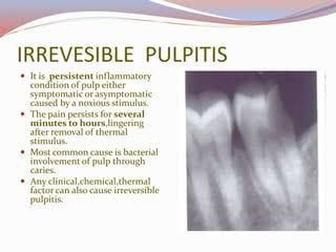 Irreversible pulpitis