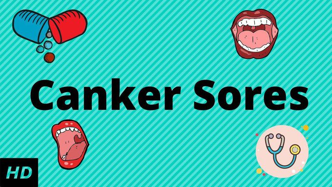 What are CANKER SORES?