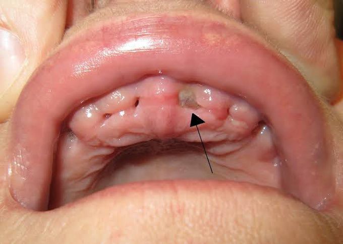 Dry socket