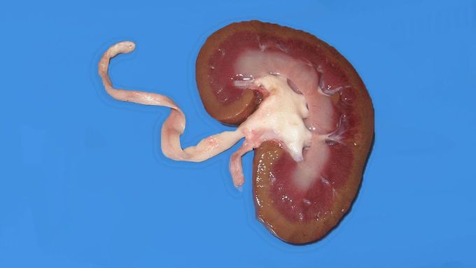 The Kidneys Of A Mom Who Took Too Many Fever Medicines.