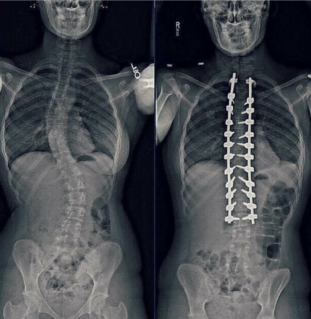 استخدام حزام اعوجاج العمود الفقري