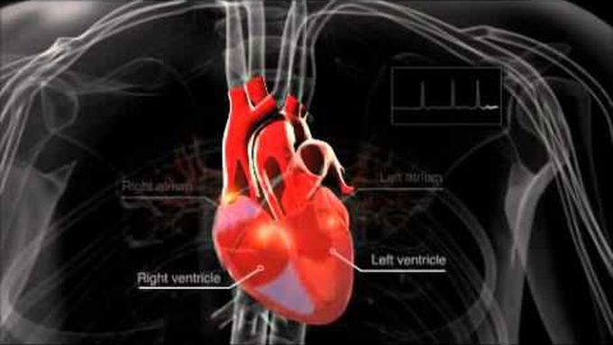 What is atrial fibrillation?