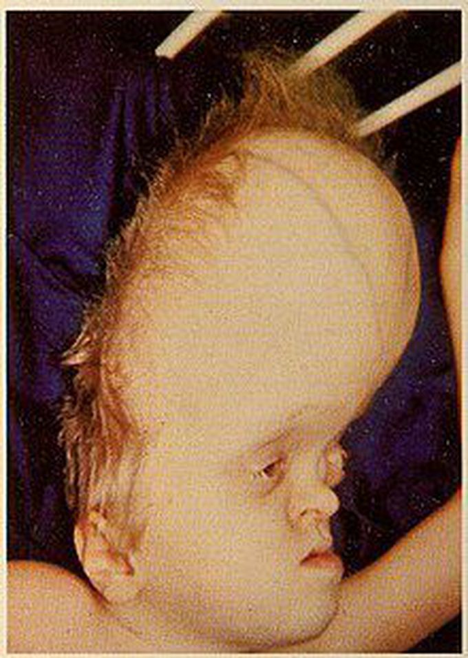 Hydrocephaly