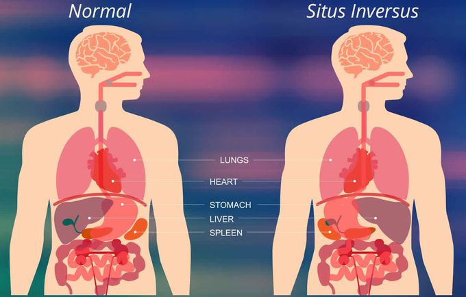 Situs Inversus