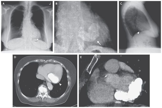 Mitral Annular Calcification