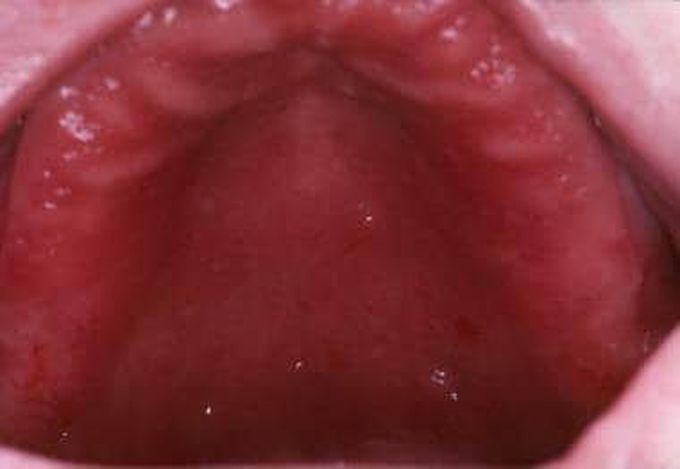 Denture Stomatitis