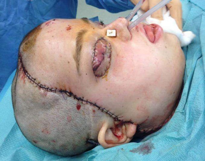 Face transplantation 😳