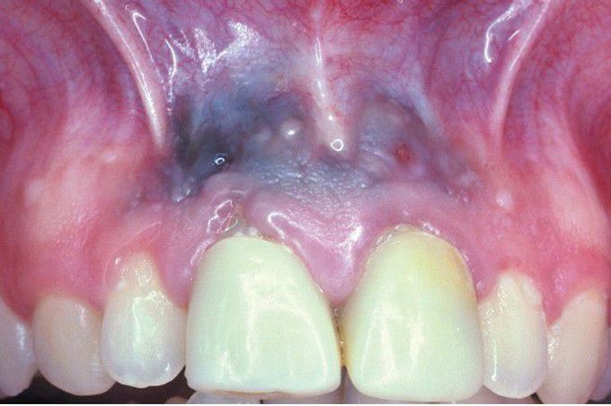 Endodontic-related Amalgam Implantation.