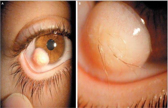 Hairy Eyeball