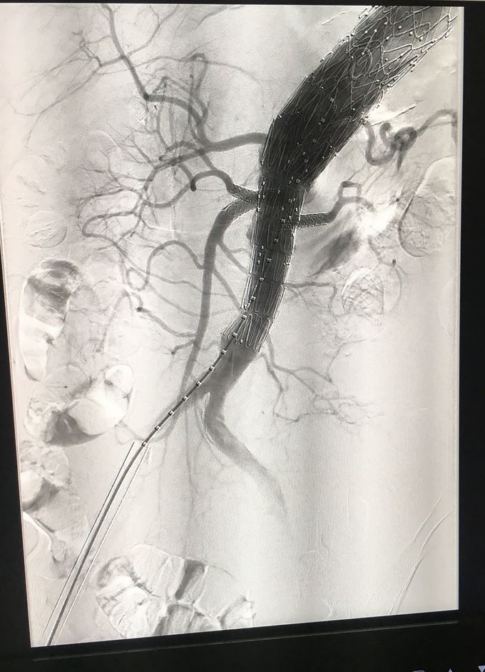 Angiography