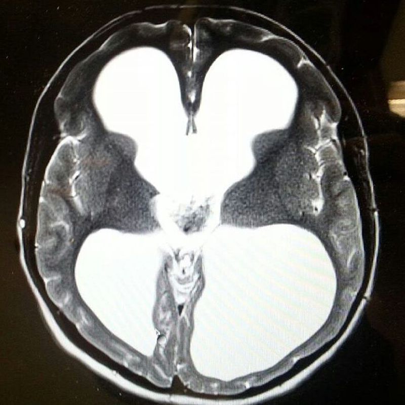 Congenital Hydrocephalus Medizzy 0828