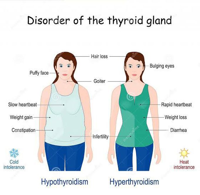 Causes of hypothyroidism