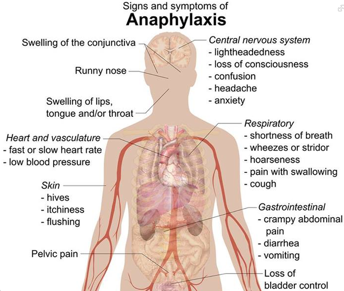 Anaphylatic Shock’s signs and symptoms!
