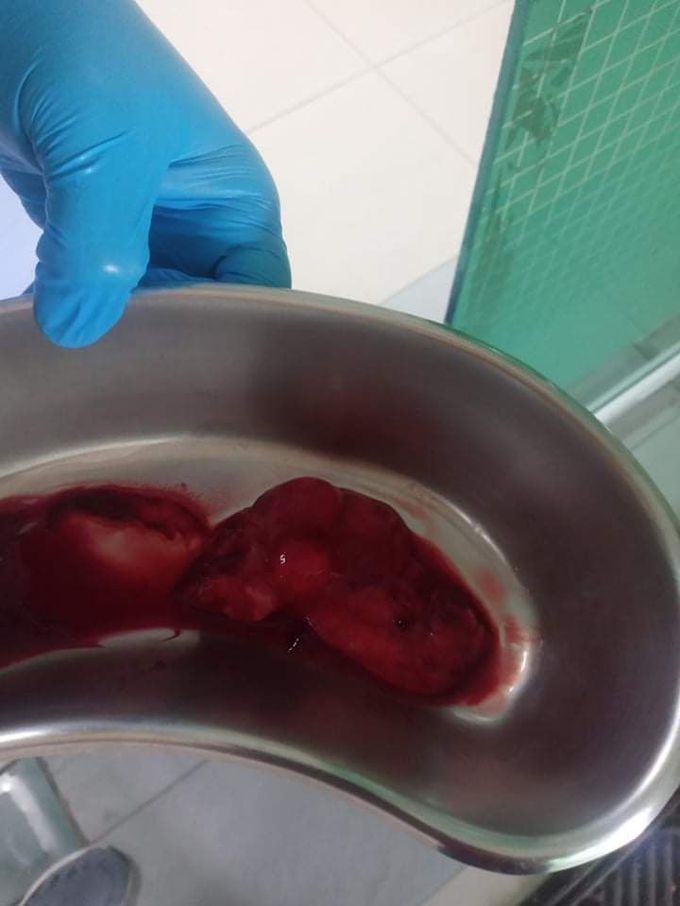 Acute Urinary Tract Infection turns to cancerous lymphnodes. What can you say about this? Anyone can share?