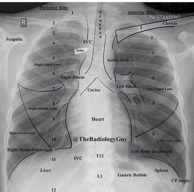 Cheat xray