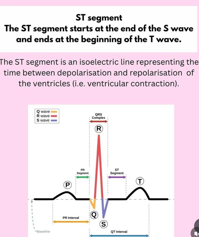 ECG Basics IV