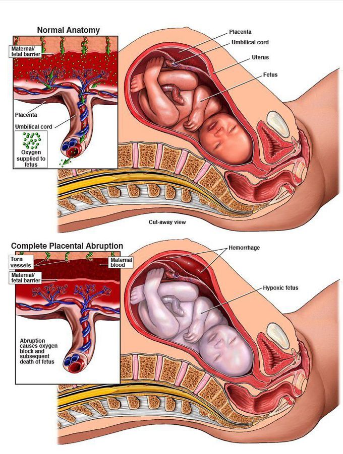 Placenta abruption