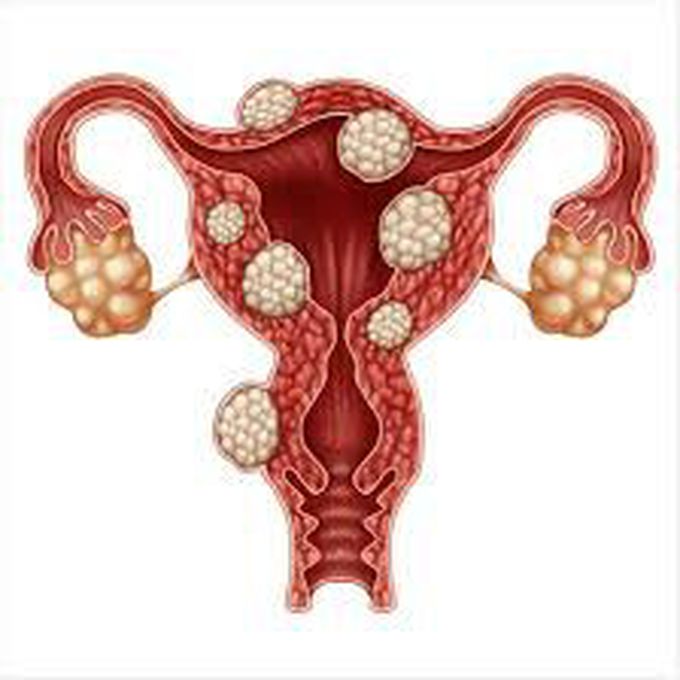 What are fibroids?