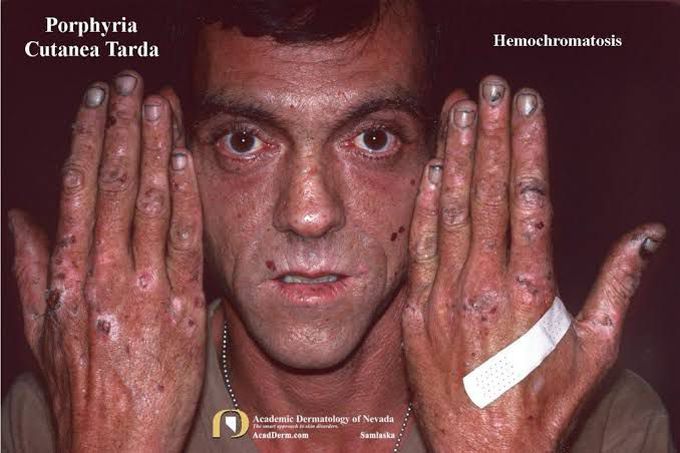 Porphyria causes