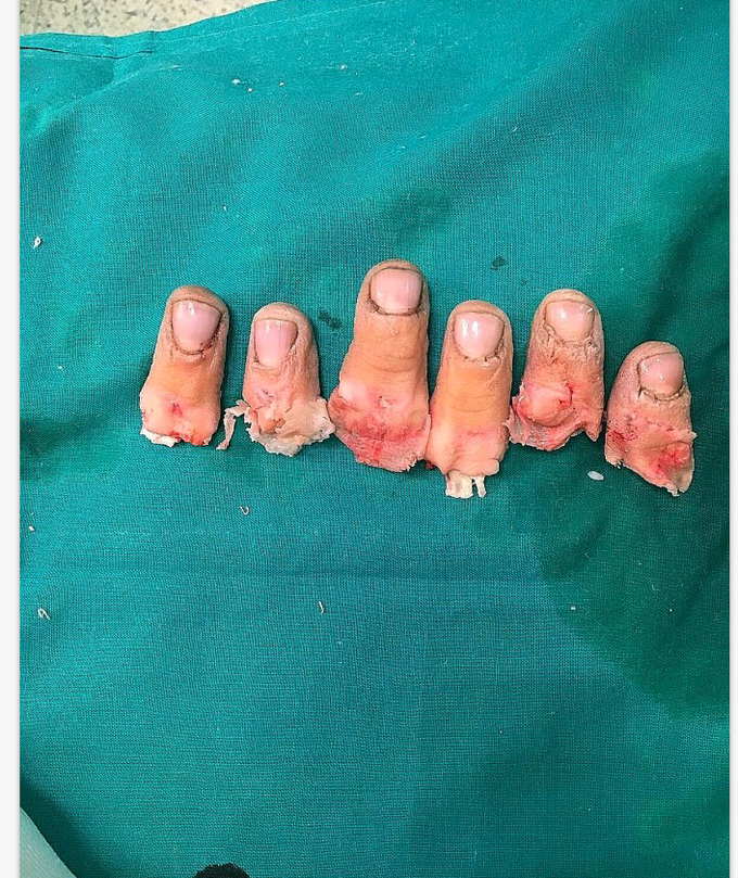 Surgery # Accident