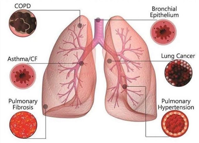 Lung Diseases - MEDizzy