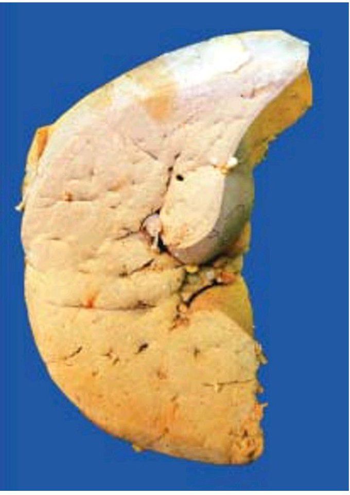 Fatty liver