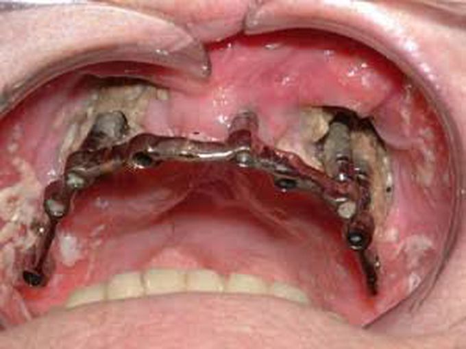 Bisphosphonate induced osteonecrosis of the jaws