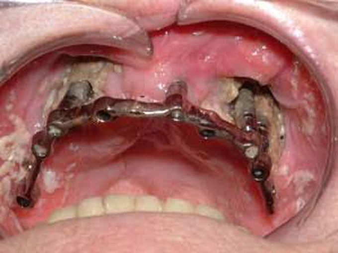 bisphosphonate associated osteonecrosis of the jaw