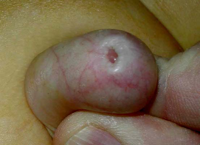 Phimosis