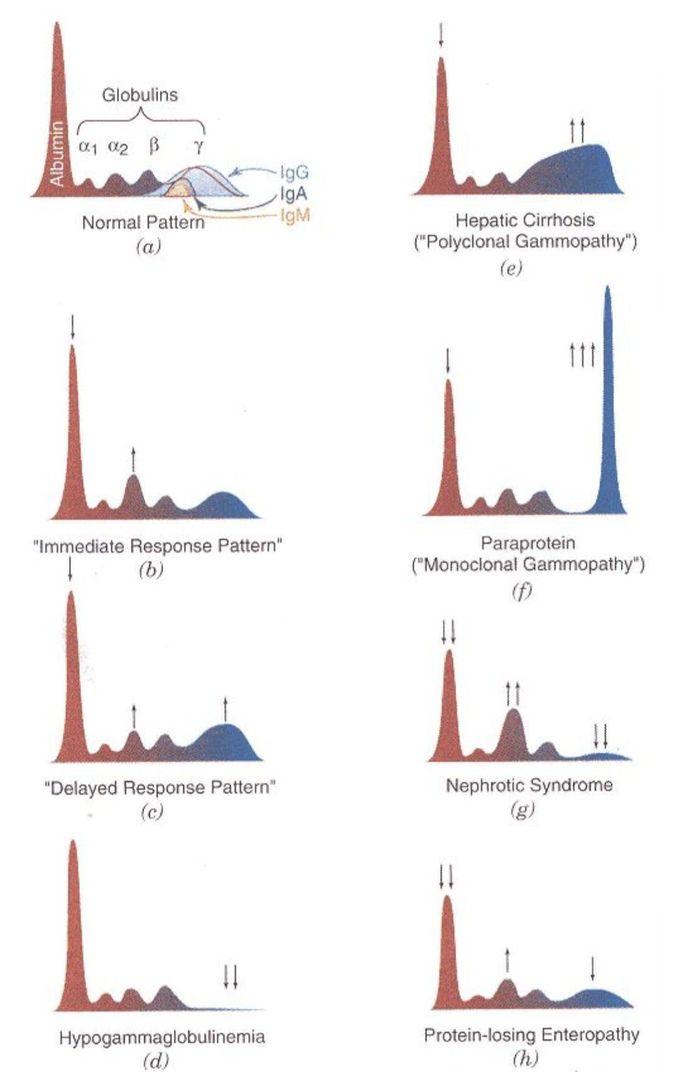 Normal serum electrophoresis and typical alterations