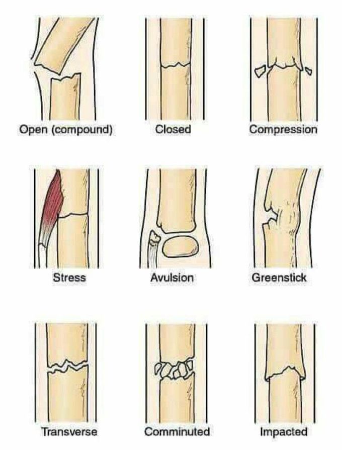 Types of fractures