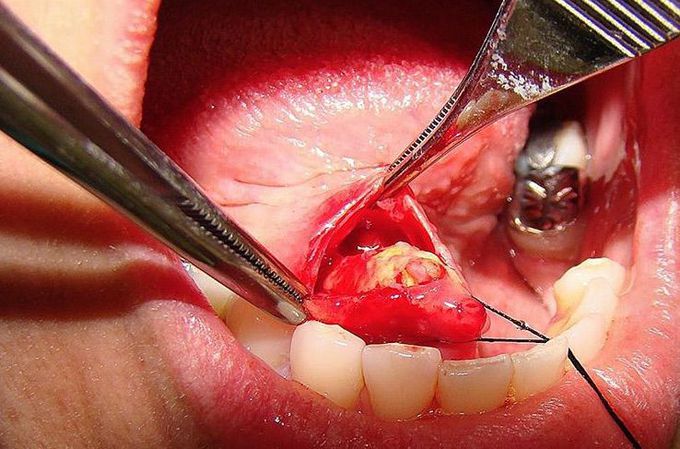 Giant sialolith located in the sibmandibular gland duct 🔪💀📚✅