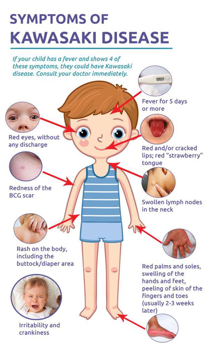 Symptoms of Kawasaki disease