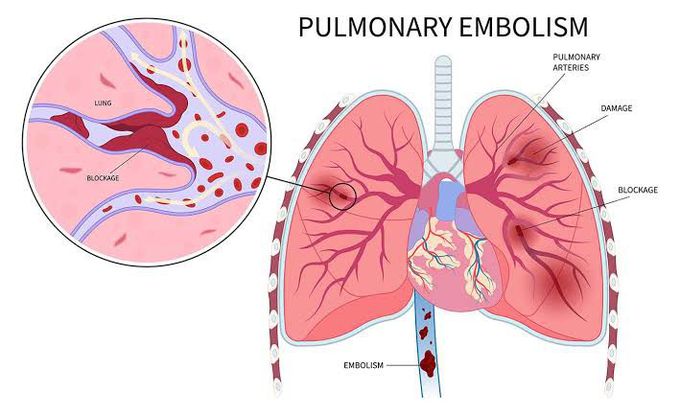 Pulmonary Embolism