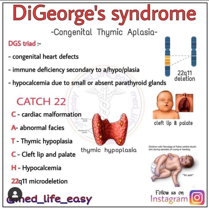 Di george syndrome