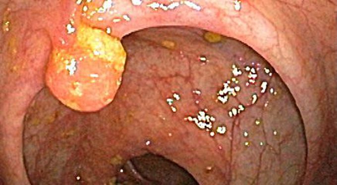 Diagnostic Criteria for HNPCC