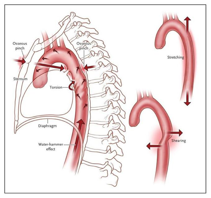 Aortic rupture after steering wheel impact in car accident