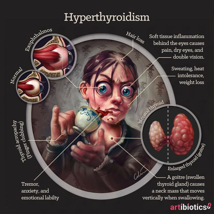 Hyperthyroidism