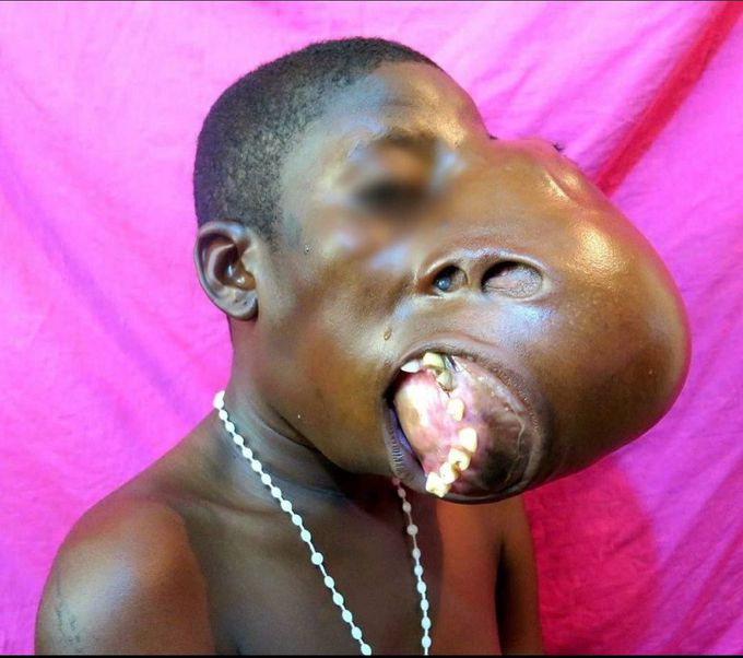 💀🦴Extreme case of craniofacial fibrous dysplasia 🦴💀