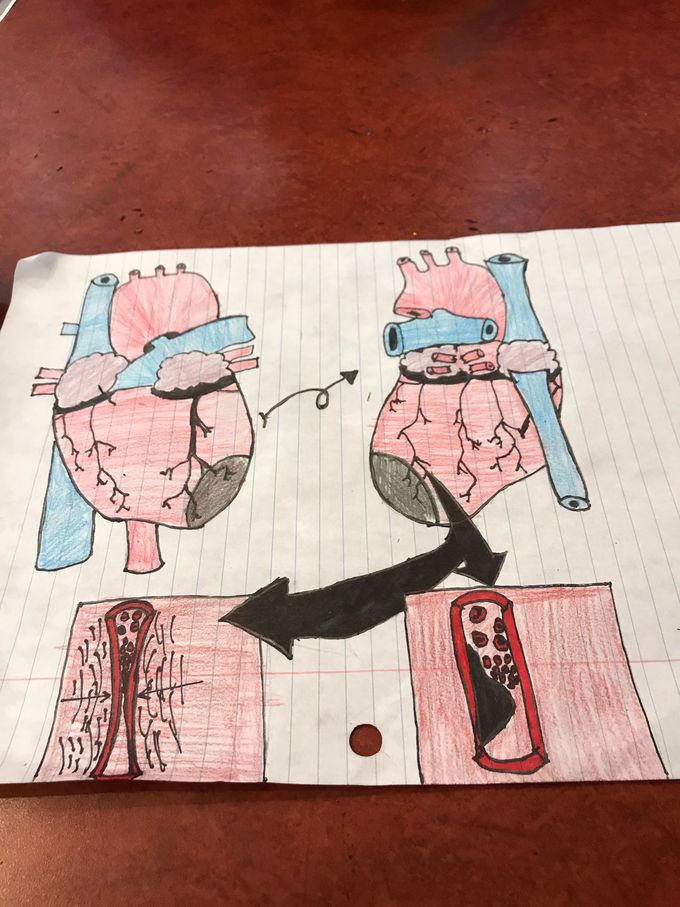 Myocardial enfarction